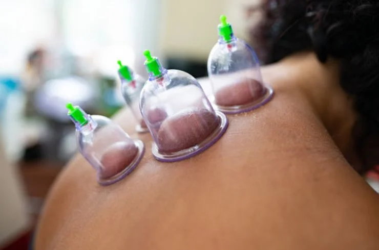 HIJAMA (CUPPING) THERAPY